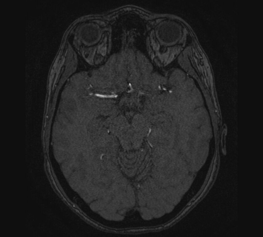 Accessory middle cerebral artery and ICA aneurysm (Radiopaedia 22656-22674 MRA 51).jpg
