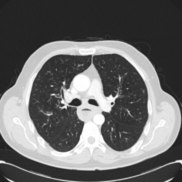 File:Achalasia (Radiopaedia 24937-25206 Axial lung window 14).jpg