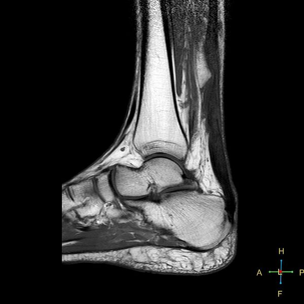 File:Achilles tendon complete tear (Radiopaedia 22834-22854 Sagittal T1 9).jpg