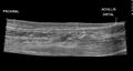 Achilles tendon tear (Radiopaedia 18551-18421 D 1).jpg