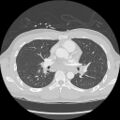 Active right ventricular cardiac sarcoidosis (Radiopaedia 55596-62101 Axial lung window 21).jpg