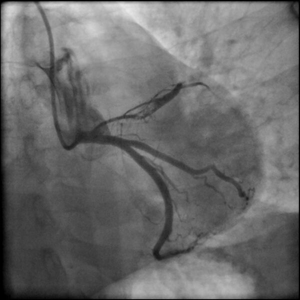 File:Acute anteroseptal myocardial infarction (Radiopaedia 68409-77946 LAO caudal (spider view) LAD and CX 28).jpg