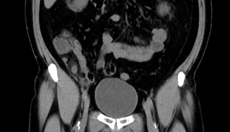File:Acute appendicitis (Radiopaedia 13030-13091 Coronal non-contrast 8).jpg