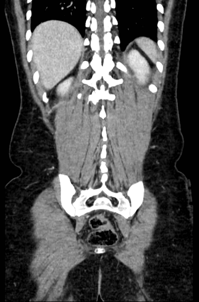 File:Acute appendicitis (Radiopaedia 22892-22918 Coronal C+ portal venous phase 49).png