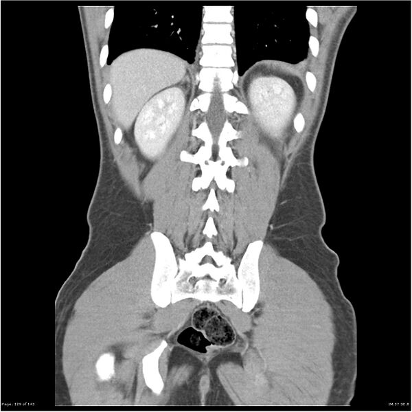 File:Acute appendicitis (Radiopaedia 25364-25615 C+ portal venous phase 26).jpg
