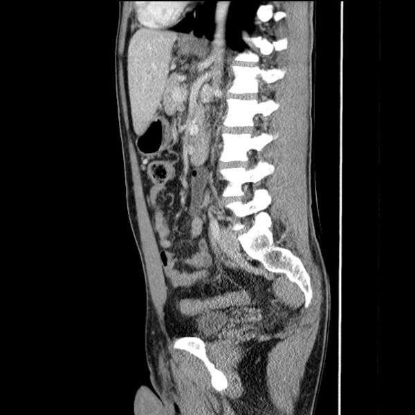 File:Acute appendicitis (Radiopaedia 27049-27227 Sagittal C+ portal venous phase 47).jpg