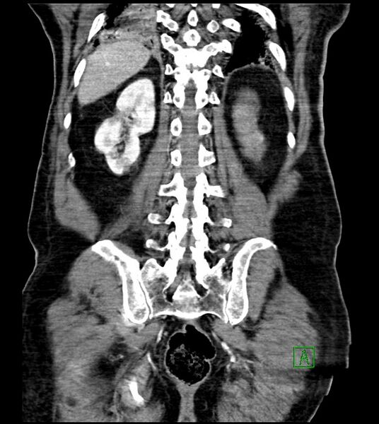 File:Acute arterial mesenteric ischemia (Radiopaedia 78238-90828 Coronal C+ portal venous phase 71).jpg