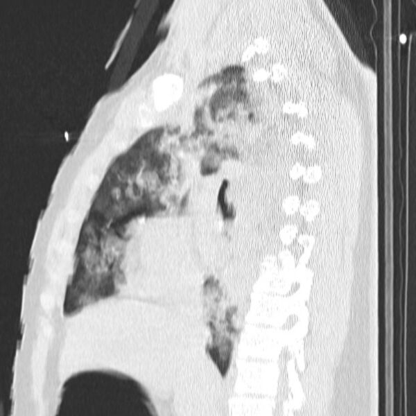File:Acute aspiration pneumonitis (Radiopaedia 33605-34703 Sagittal lung window 40).jpg