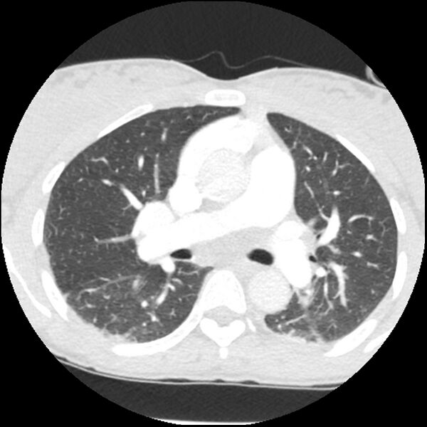 File:Acute chest syndrome - sickle cell disease (Radiopaedia 42375-45499 Axial lung window 85).jpg