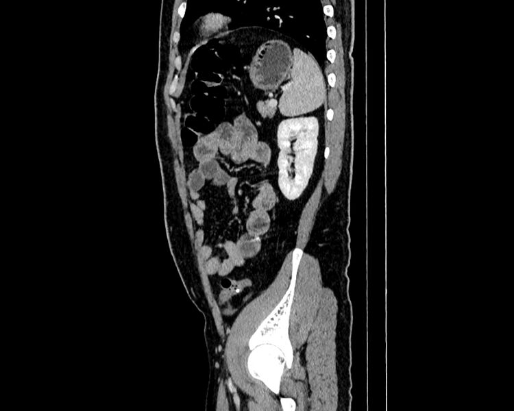 File:Acute cholecystitis (Radiopaedia 53216-59182 Sagittal C+ portal venous phase 18).jpg