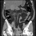 Acute cholecystitis and ureteric colic (Radiopaedia 42330-45444 Coronal prone 48).jpg