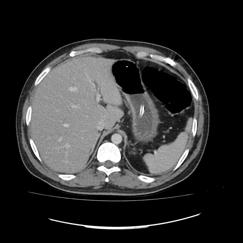 Acute mesenteric ischemia - superior mesenteric artery thrombosis (Radiopaedia 73947-84776 Axial C+ portal venous phase 2).jpg