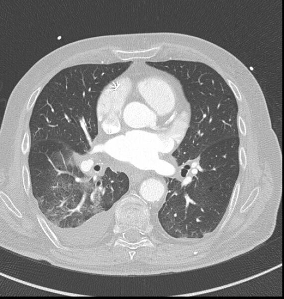 File:Acute myocardial infarction (Radiopaedia 23413-23481 lung window 33).jpg