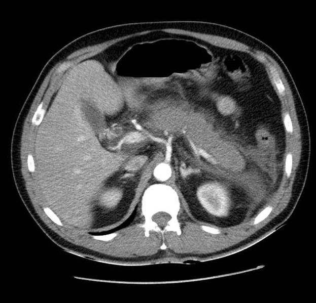 File:Acute pancreatitis - Balthazar E (Radiopaedia 23080-23110 Axial C+ arterial phase 20).jpg