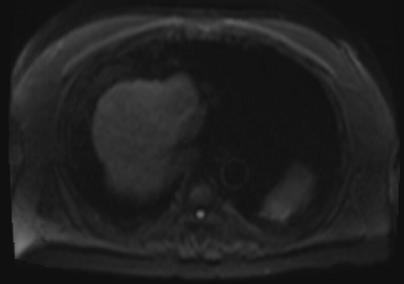 File:Acute portal vein thrombosis (Radiopaedia 73198-83925 Axial DWI 37).jpg