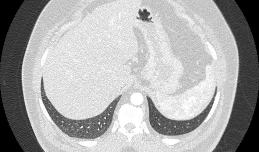 Acute pulmonary embolism with pulmonary infarcts (Radiopaedia 77688-89908 Axial lung window 124).jpg