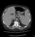 Acute renal failure post IV contrast injection- CT findings (Radiopaedia 47815-52557 Axial non-contrast 21).jpg