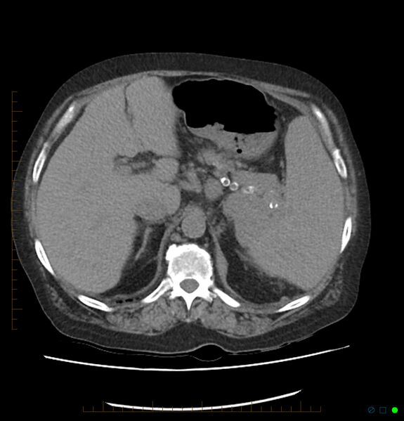 File:Acute renal failure post IV contrast injection- CT findings (Radiopaedia 47815-52557 Axial non-contrast 21).jpg