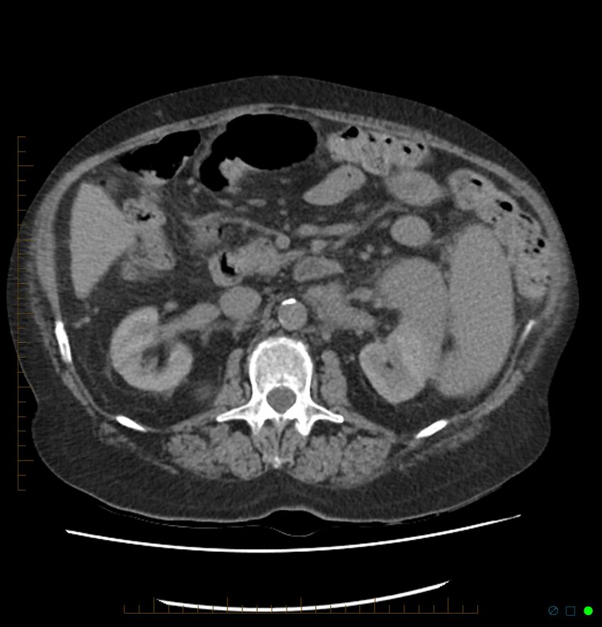 Acute renal failure post IV contrast injection- CT findings (Radiopaedia 47815-52557 Axial non-contrast 33).jpg