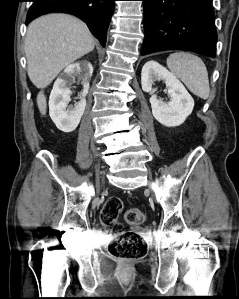 File:Acute renal infarction - rim capsular enhancement (Radiopaedia 59833-67270 Coronal C+ portal venous phase 40).jpg