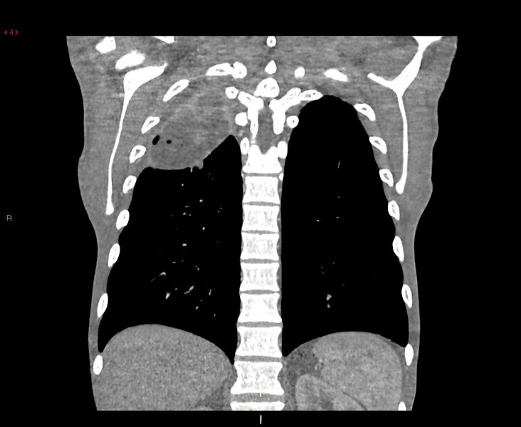 File:Acute right lung abscess (Radiopaedia 34806-36258 Coronal C+ arterial phase 12).jpg