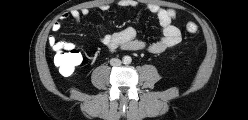 Acute sigmoid colon diverticulitis (Radiopaedia 55507-61976 Axial C+ portal venous phase 38).jpg