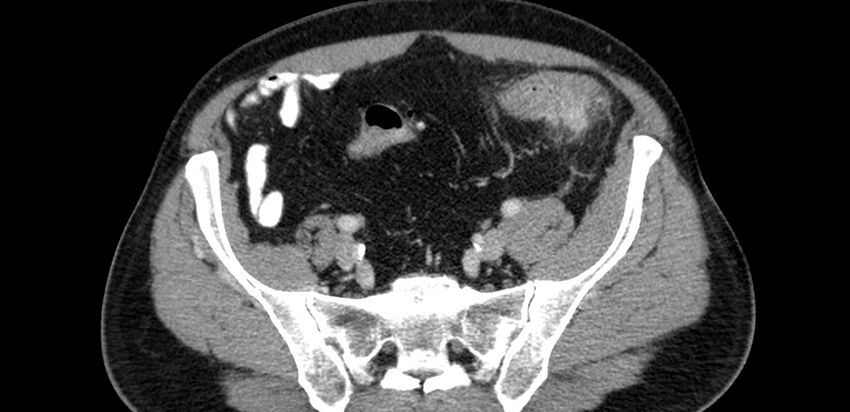 Acute sigmoid colon diverticulitis (Radiopaedia 55507-61976 Axial C+ portal venous phase 75).jpg