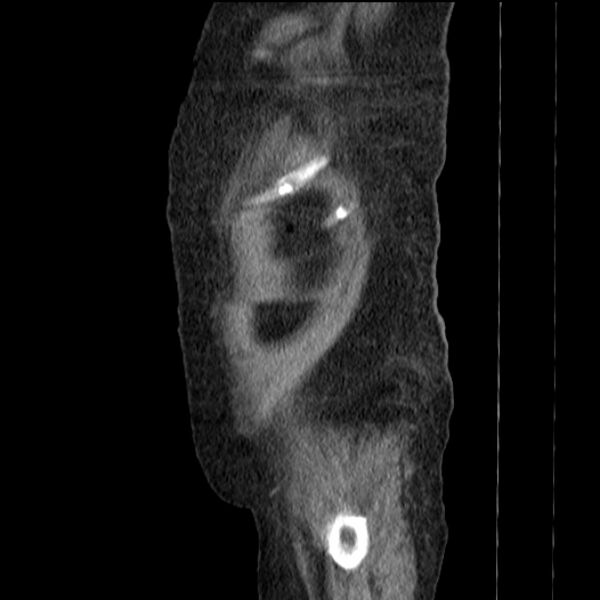 File:Acute tubular necrosis (Radiopaedia 28077-28334 Sagittal non-contrast 80).jpg