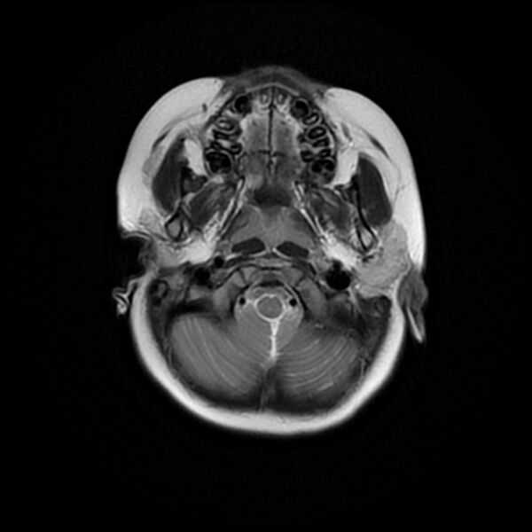 File:Adamantinomatous craniopharyngioma (Radiopaedia 77407-89529 Axial T2 3).jpg