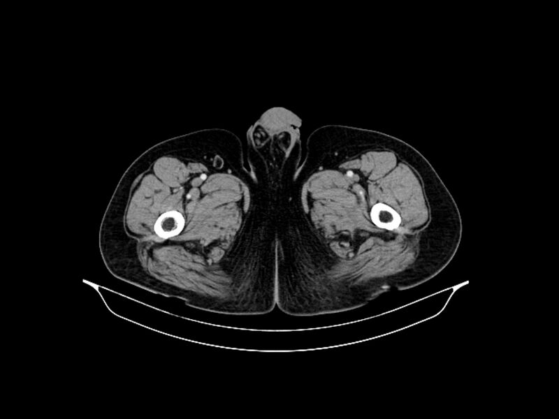 File:Adenocarcinoma of pancreas with hepatic metastasis (Radiopaedia 64332-73122 Axial C+ portal venous phase 113).jpg