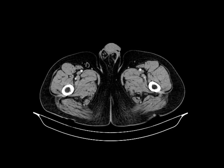 Adenocarcinoma of pancreas with hepatic metastasis (Radiopaedia 64332-73122 Axial C+ portal venous phase 113).jpg