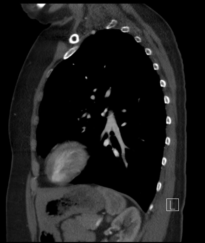 Adenocarcinoma of the lung (Radiopaedia 44205-47803 Sagittal C+ portal venous phase 19).jpg