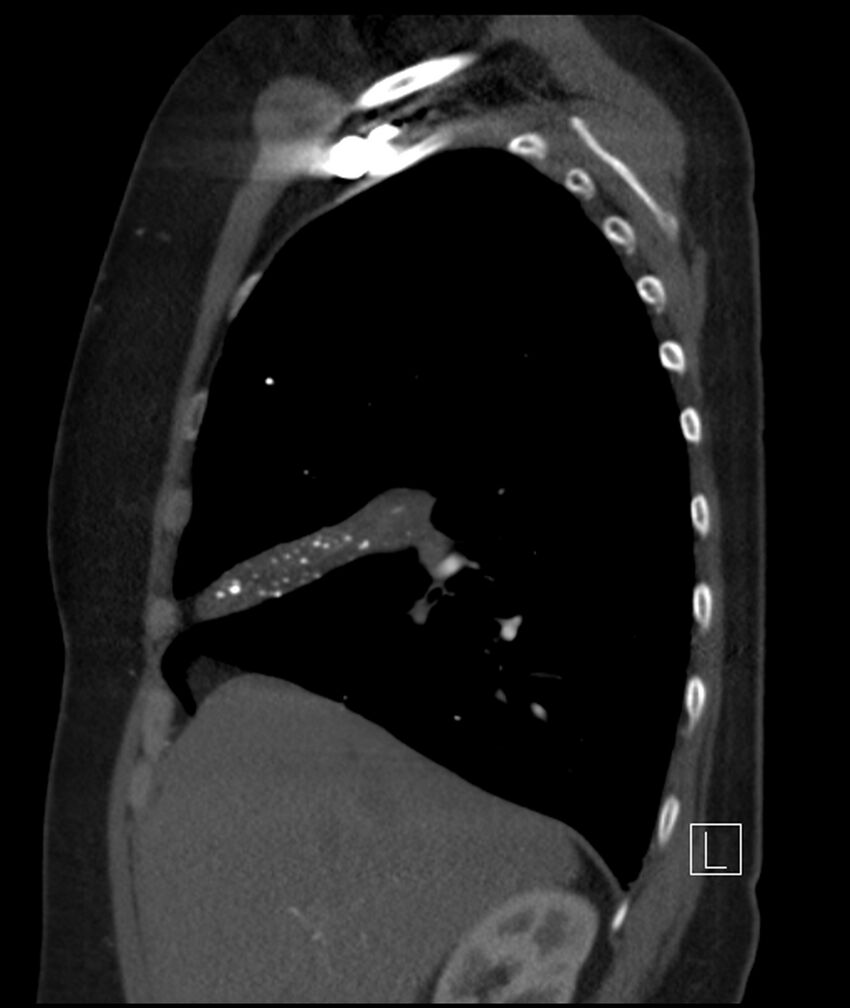 Adenocarcinoma of the lung (Radiopaedia 44205-47803 Sagittal C+ portal venous phase 40).jpg
