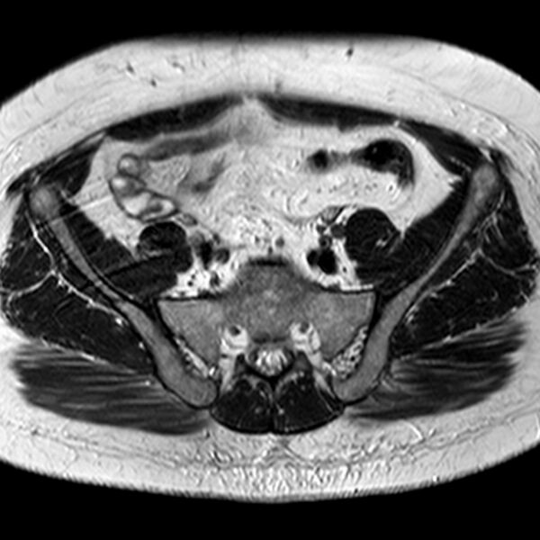 File:Adenomyoma of the uterus (Radiopaedia 9871-10439 Axial T2 27).jpg