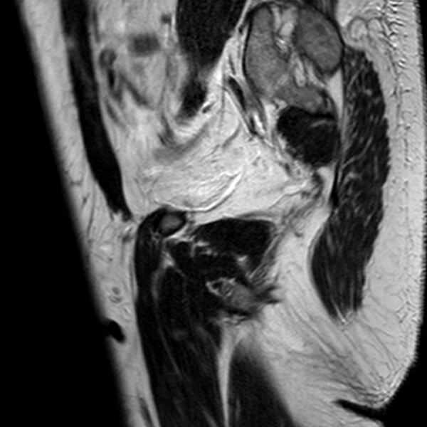 File:Adenomyoma of the uterus (Radiopaedia 9871-10439 Sagittal T2 22).jpg