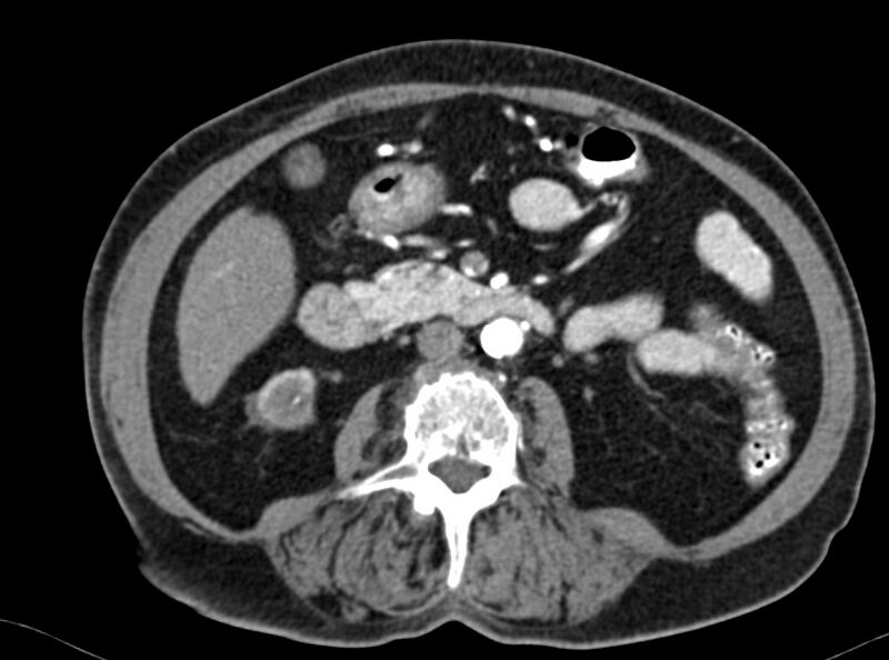 File:Adenomyomatosis of the gallbladder (Radiopaedia 12142-12483 Axial C+ arterial phase 21).jpg