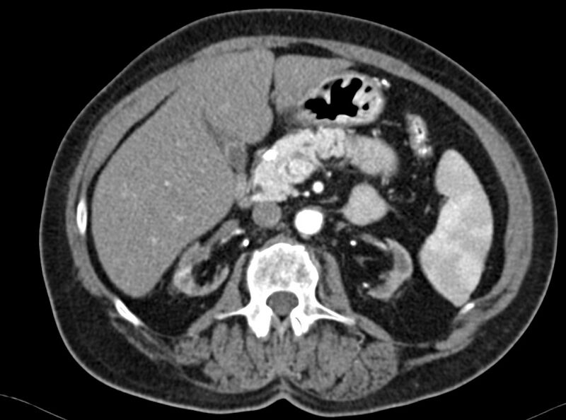 File:Adenomyomatosis of the gallbladder (Radiopaedia 12142-12483 Axial C+ arterial phase 9).jpg