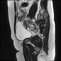 Adenomyosis - ovarian endometriomas (Radiopaedia 67031-76350 Sagittal T2 21).jpg
