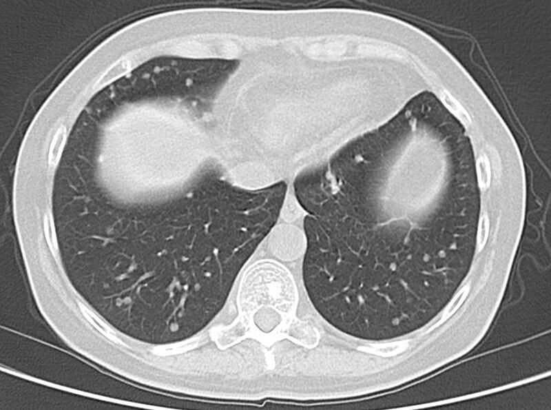 File:Adenosquamous lung carcinoma (Radiopaedia 22035-22030 lung window 47).jpg
