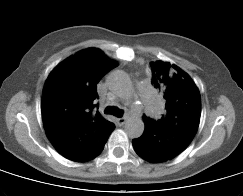 Adenosquamous lung carcinoma (Radiopaedia 22035-22030 non-contrast 26).jpg