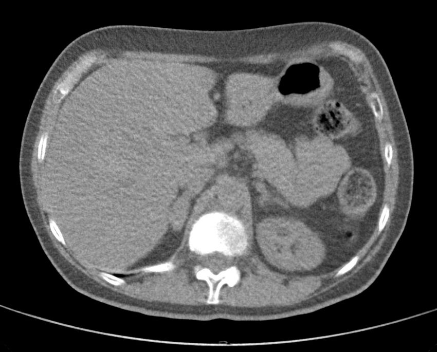 Adenosquamous lung carcinoma (Radiopaedia 22035-22030 non-contrast 60).jpg