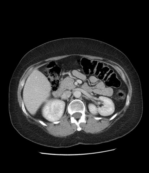 File:Adrenal cortical carcinoma with IVC invasion and thrombosis (Radiopaedia 34307-35597 Axial C+ portal venous phase 33).jpg