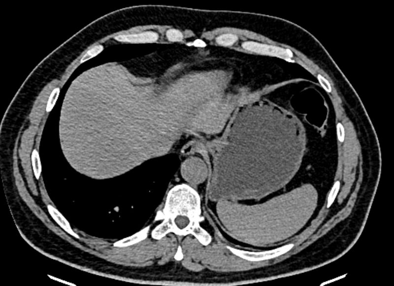 File:Adrenal metastases (Radiopaedia 73082-83791 Axial non-contrast 21).jpg