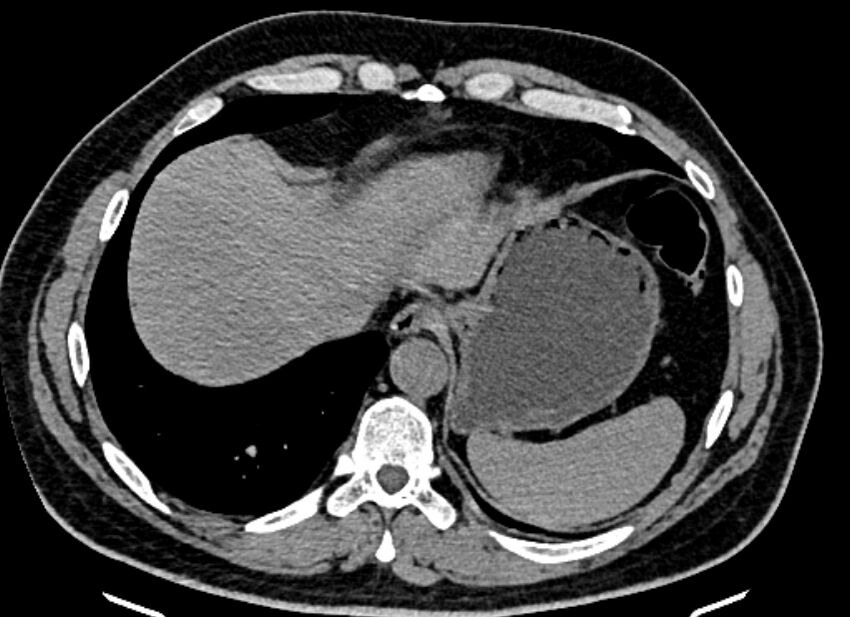 Adrenal metastases (Radiopaedia 73082-83791 Axial non-contrast 21).jpg