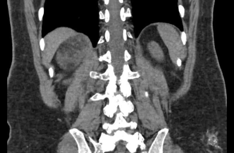 File:Adrenal myelolipoma (Radiopaedia 65240-74253 Coronal non-contrast 58).jpg