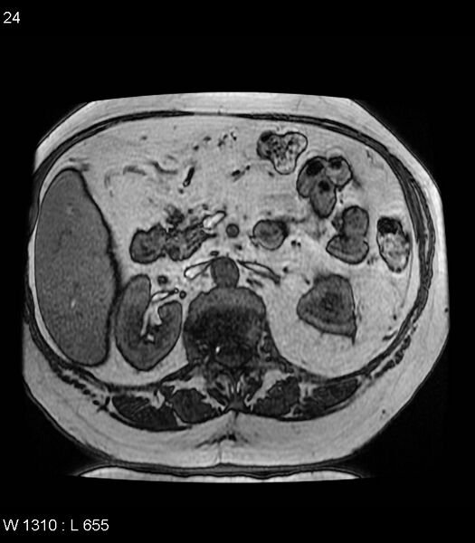 File:Adrenal myelolipoma (Radiopaedia 6765-7961 Axial T1 out-of-phase 24).jpg