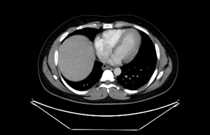 Adrenocortical carcinoma (Radiopaedia 80134-93438 Axial C+ portal venous phase 9).jpg