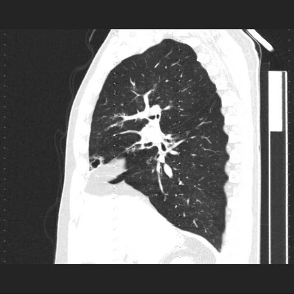 File:Allergic bronchopulmonary aspergillosis (Radiopaedia 21386-21320 Sagittal lung window 12).jpg
