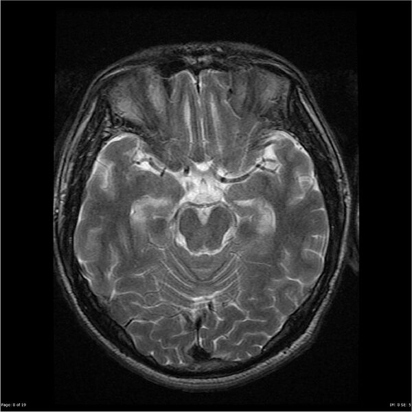 File:Amnestic syndrome secondary to hypoxic brain injury (Radiopaedia 24743-25004 T2 8).jpg