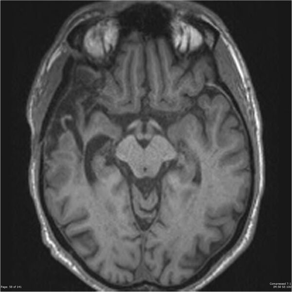 File:Anaplastic meningioma with recurrence (Radiopaedia 34452-35788 Axial T1 56).jpg